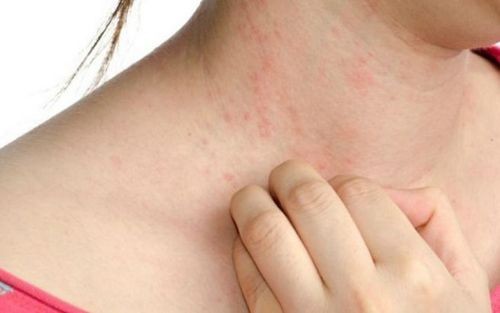 Người bệnh có thể gặp triệu chứng phát ban do tác dụng phụ của thuốc gây ra