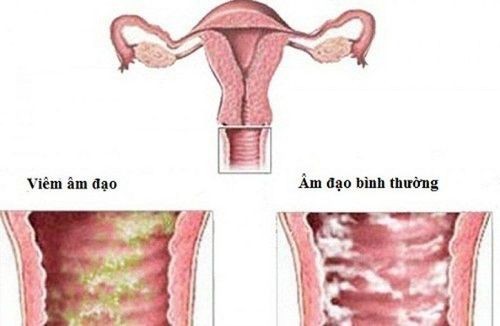 Quên uống thuốc ngừa thai và bị ra máu âm đạo khi dùng thuốc điều trị viêm âm đạo phải làm gì?