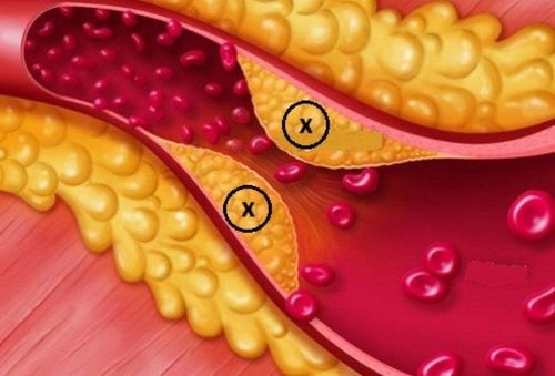 Hình ảnh minh họa về rối loạn lipid máu