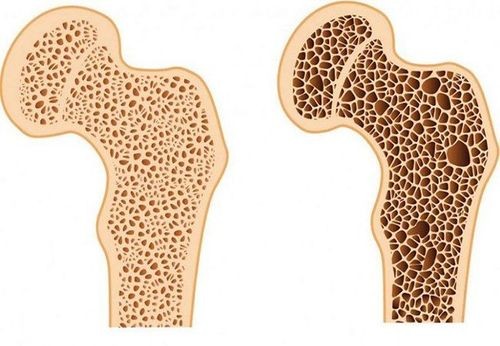 Khi nào cần chỉ định thuốc điều trị loãng xương?